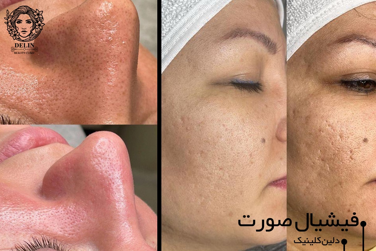 بهترین-مرکز-پاکسازی-پوست-بلوار-فردوس-غرب-تهران