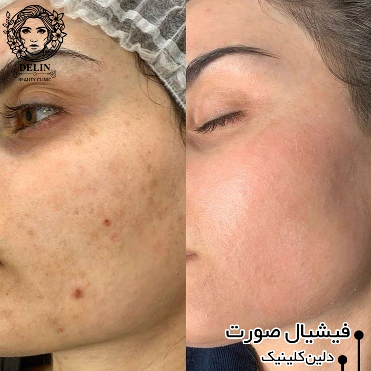 فیشیال صورت بلوار فردوس